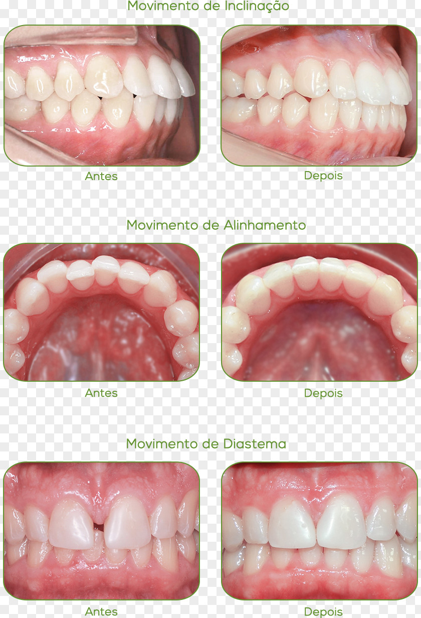 Health Case Report Jaw Orthodontics Acetate PNG