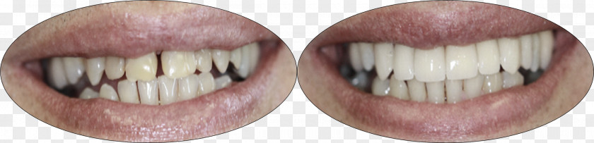 Crown Tooth Arraval Monique DDS Professional Dental Associates Dentistry PNG