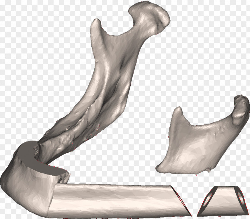 Mandibular Advancement Splints Fibula Surgery Mandible Osteotomy Bone PNG