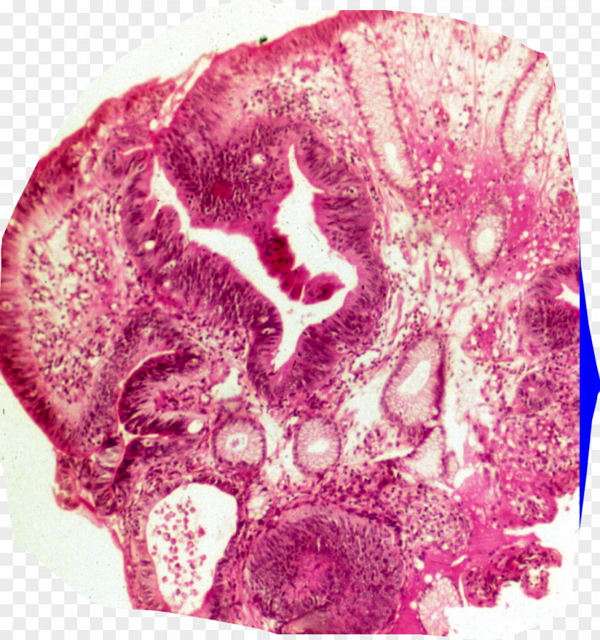 Gastrointestinal Stromal Tumor Organism Pink M PNG