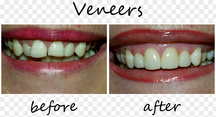 Tooth Veneer Dentistry Patient PNG
