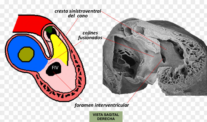Interventricular Septum Primary Foramen Embriologia Humana Foramina Embryology PNG