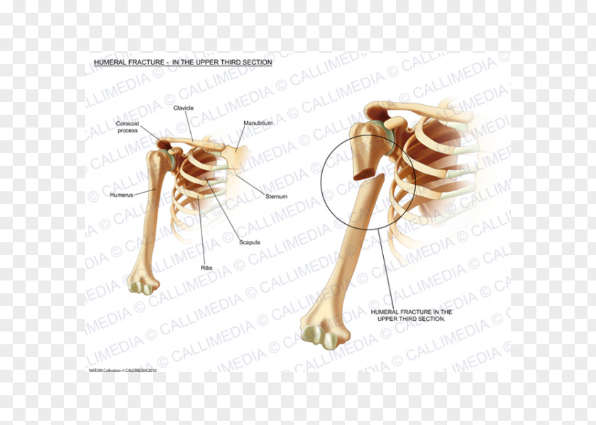 Humerus Fracture Bone Injury Sternum PNG