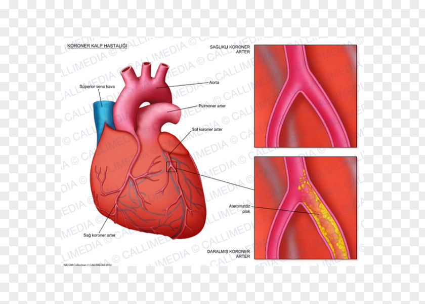 Heart Coronary Artery Disease Arteries Cardiology Cardiovascular PNG