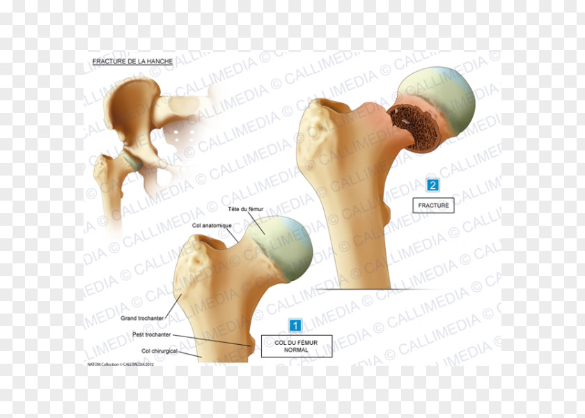 Fractures Hip Fracture Shoulder Bone Femur PNG