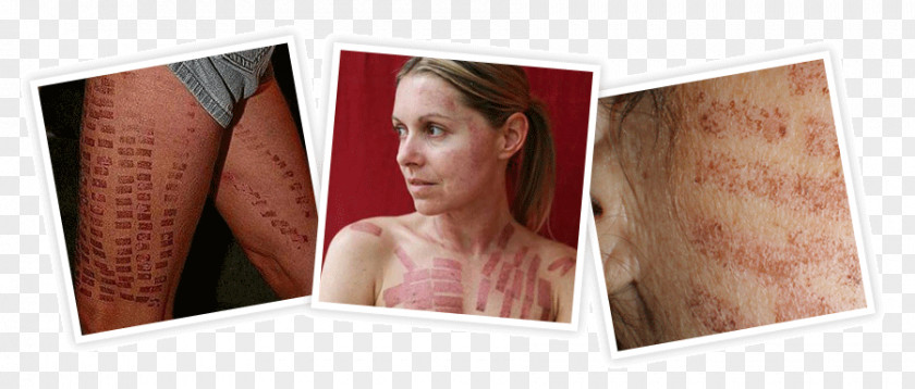 Laser Peel Burns Hair Removal Video Tattoo PNG