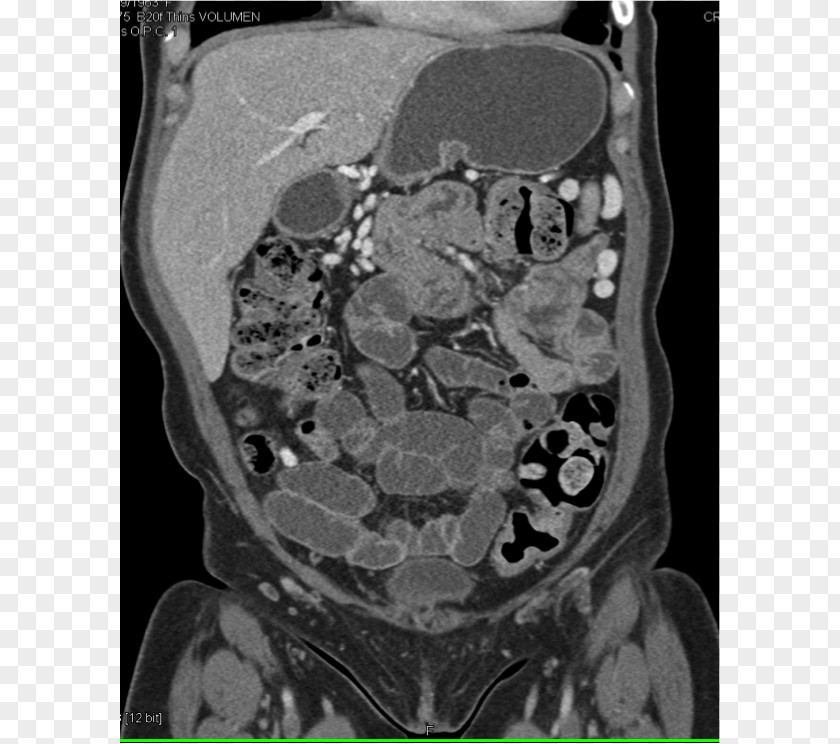 Carcinoid Computed Tomography Radiology Medical Radiography X-ray PNG