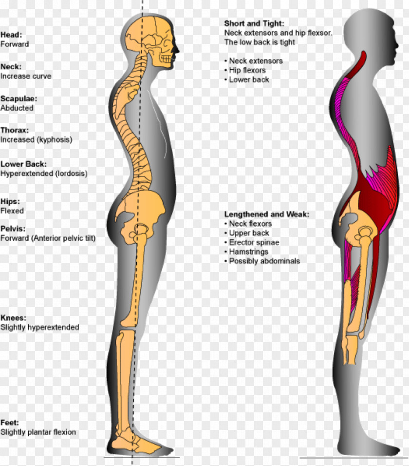 Girdle Lordosis Human Back Low Pain Hypermobility PNG