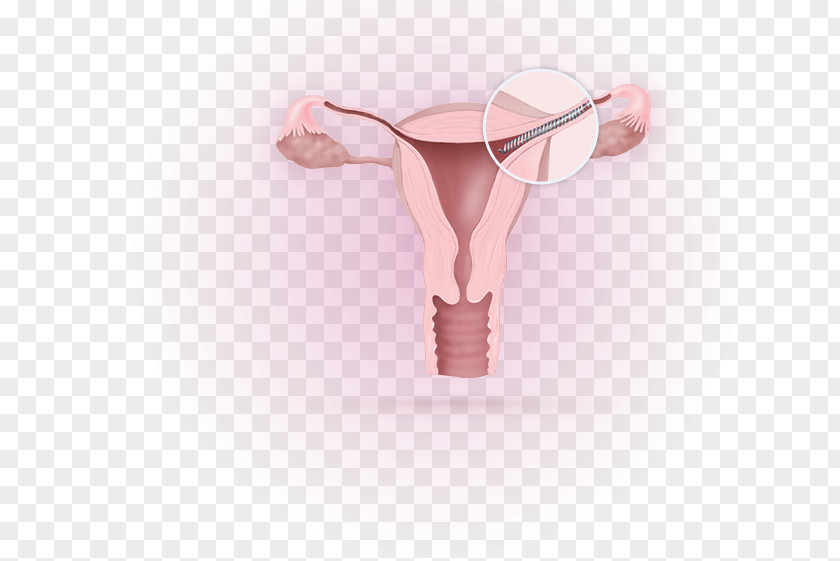 Woman Essure Birth Control Fallopian Tube Sterilization Tubal Ligation PNG
