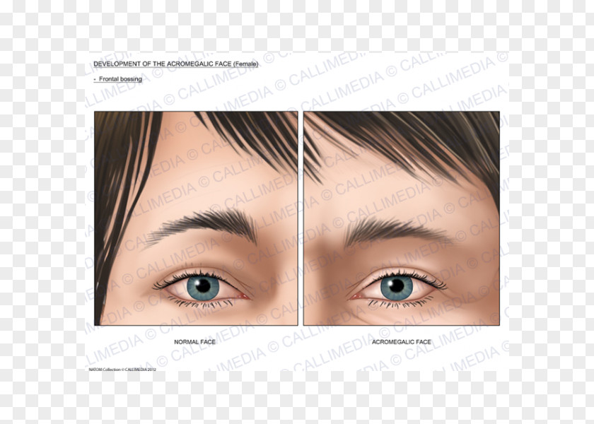 Acromegaly Skull Bossing Frontal Bone Sinus Endocrinology PNG