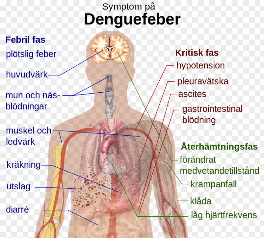 Health Dengue Virus Symptom Viral Hemorrhagic Fever PNG