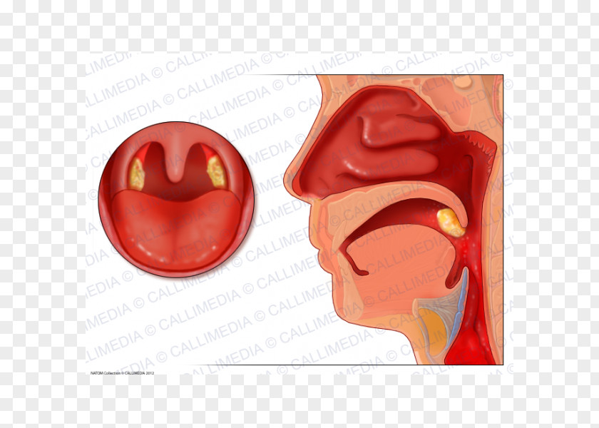 Nose Tonsillitis Adenoid Pharynx Otorhinolaryngology PNG