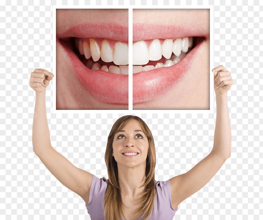 Tooth Surgery Whitening Dentistry Human PNG