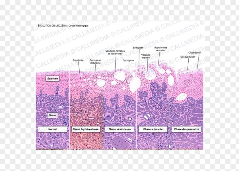 Eczema Introduction To Histology Dermatitis Keratinocyte Corte Histológico PNG