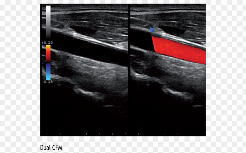 Advanced Technology Ultrasonography Common Carotid Artery Ultrasound Cardiovascular Disease Cardiology PNG