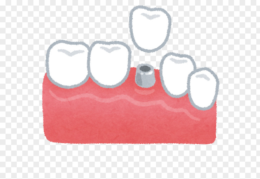 Tooth Implant Dentist Dental Therapy Dentures PNG