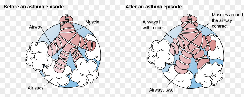 Lung Asthma Bronchus Dyspnea Bronchospasm Disease PNG