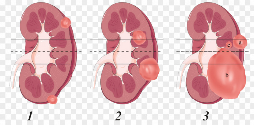 Kidney Tumour Nephrectomy Renal Cell Carcinoma Anatomy PNG