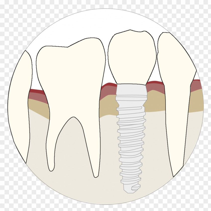 Augmentation Tooth Velopex International Dentistry Dental Implant Abrasion PNG
