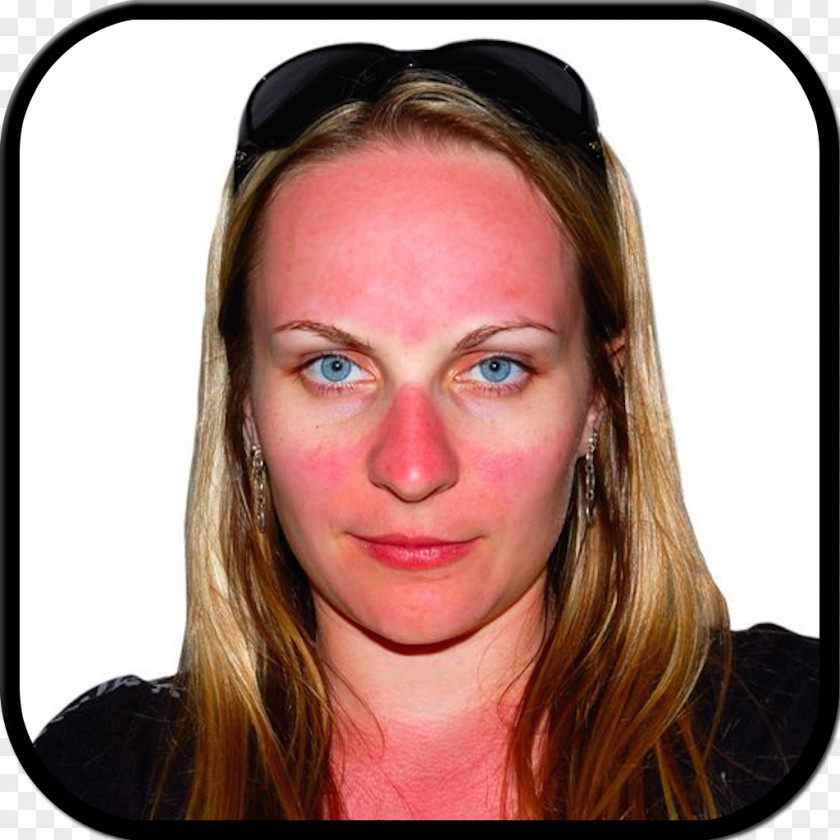 Burn Sunburn Skin Face PNG