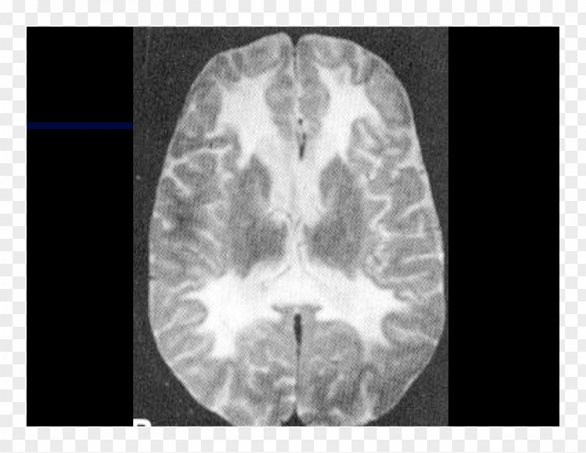Brain Computed Tomography Lääketieteellinen Röntgenkuvaus X-ray Radiography PNG