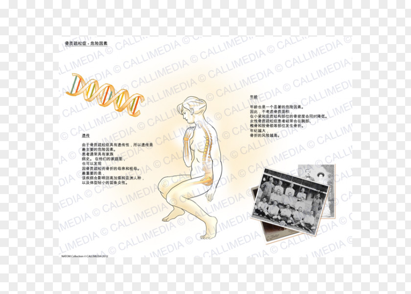 Osteoporosis Risk Factor Rheumatology Osteopenia PNG