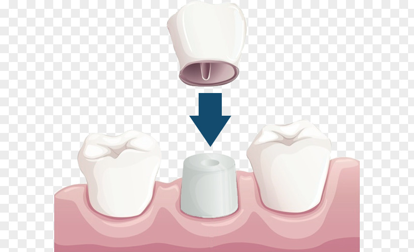 Crown Dentistry Dental Restoration Bridge PNG