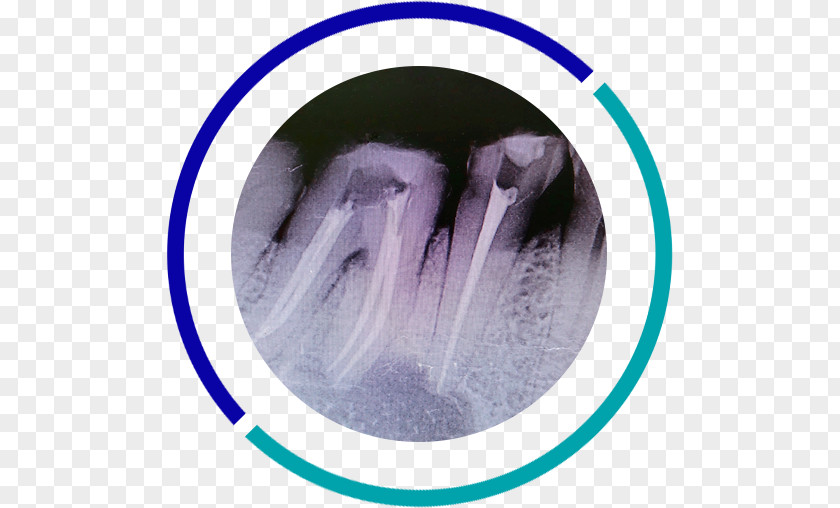 Endodoncia Dentistry Tooth Apicoectomy Root Canal PNG