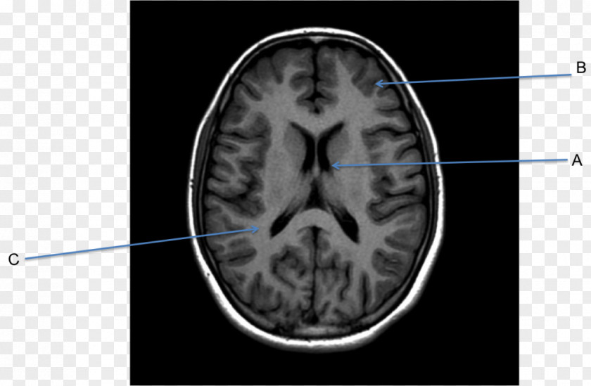 African American Business Magnetic Resonance Imaging Of The Brain Computed Tomography Neuroimaging PNG