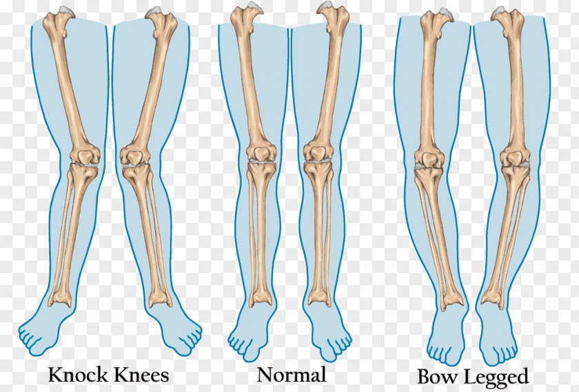 Genu Valgum Varum Human Leg Knee Foot PNG valgum varum leg Foot, joint pain clipart PNG