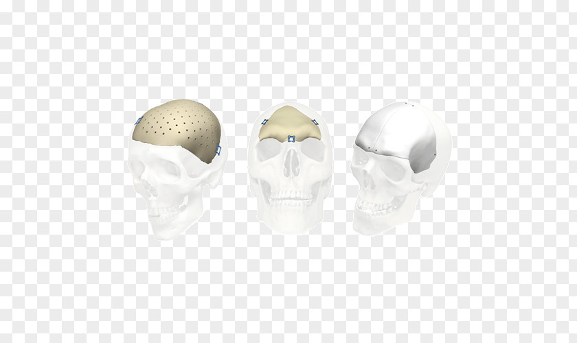 Implants Skull Stryker Corporation Implant Jaw Bone PNG