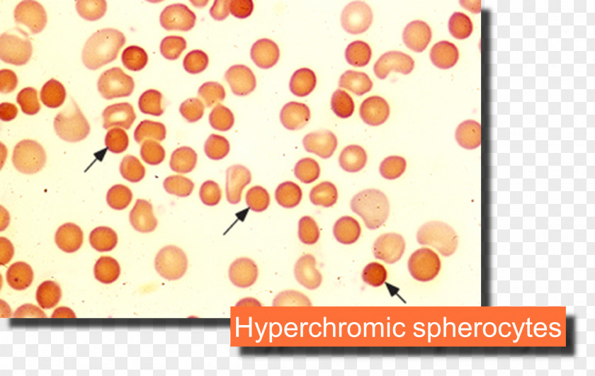 Blood Microangiopathic Hemolytic Anemia Hemolysis PNG
