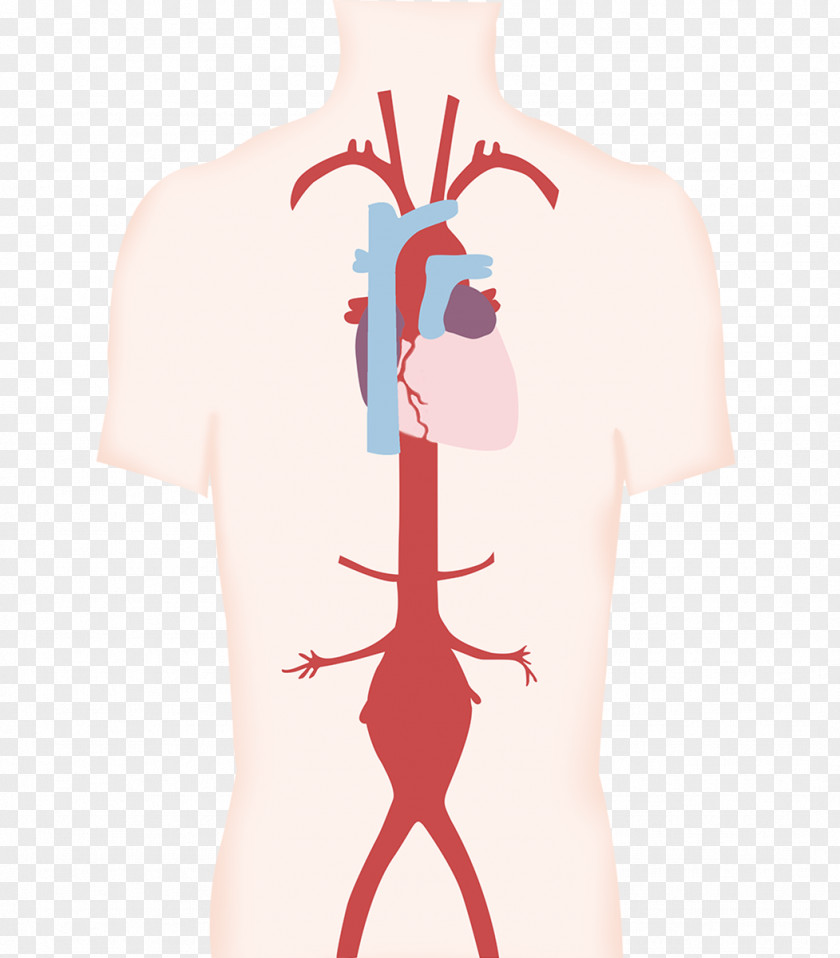 Heart Aneurysm Artery Blood Vessel Aorta Thumb PNG
