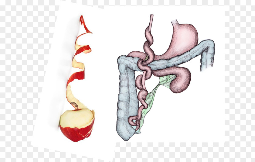 Intestine Intestinal Atresia Large Jejunum Stenosis PNG