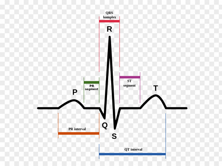 Ecg Electrocardiography Heart Sinus Rhythm QRS Complex Cardiac Arrest PNG