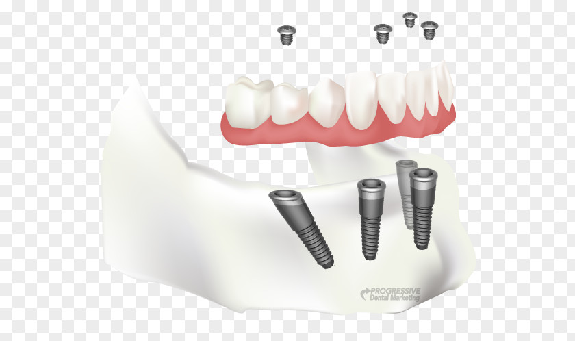 Permanent Teeth Tooth Dental Implant Dentistry All-on-4 PNG