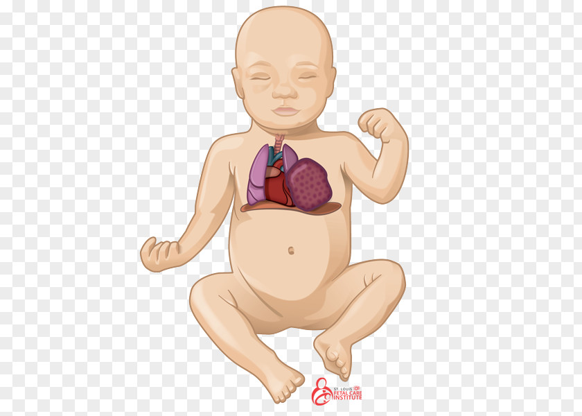 Pregnancy Pulmonary Hypoplasia Lung Congenital Airway Malformation Sequestration PNG