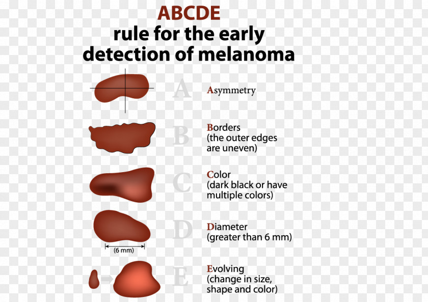 Melanoma Skin Cancer Basal-cell Carcinoma PNG