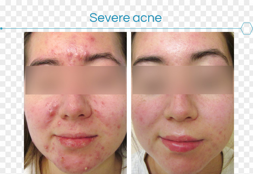 Acne Skin Face Dermatology Therapy PNG