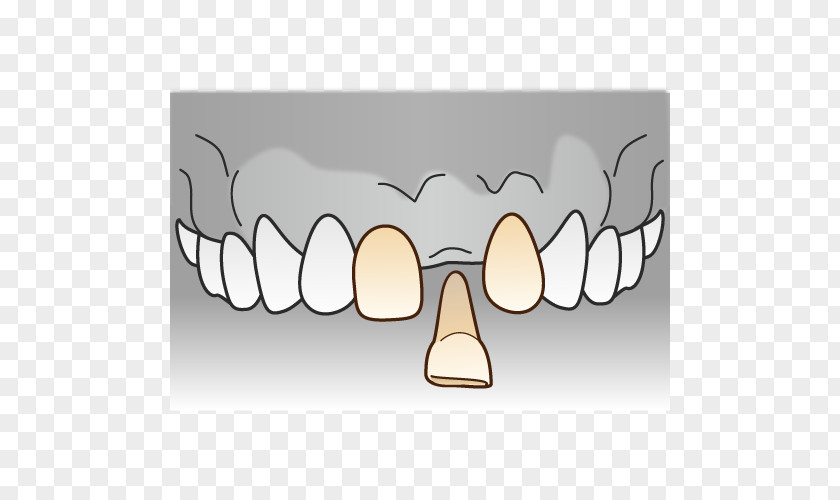 Bridge Tooth Dentist Dentures 審美歯科 PNG