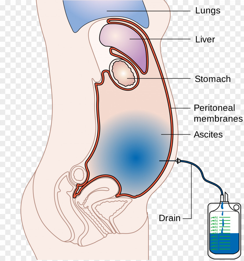 Adrenal Gland Ascites Paracentesis Abdomen Cirrhosis Peritoneum PNG