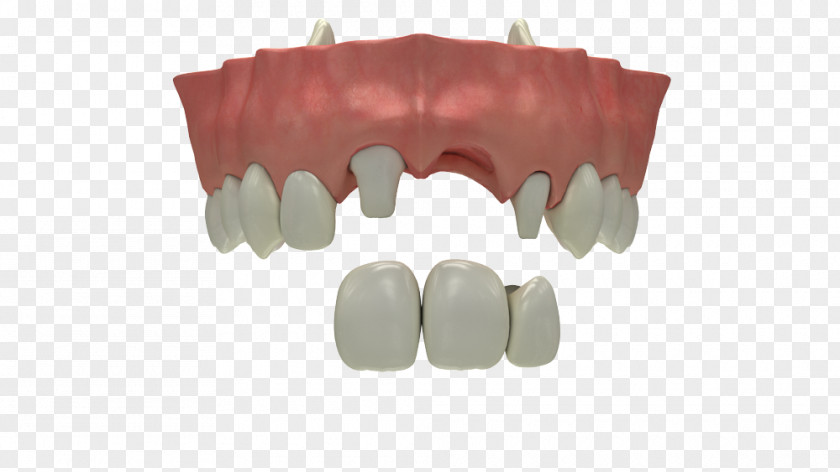 Tooth Loss Dental Implant Dentistry Human PNG