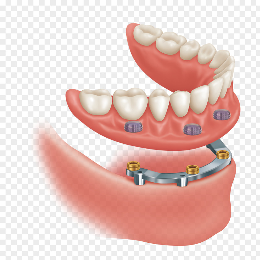 Implant Dentistry Abutment Dental Precision Attachment Dentures PNG