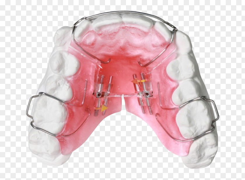 Health Orthodontics Dental Braces Dentist Retainer Tooth PNG