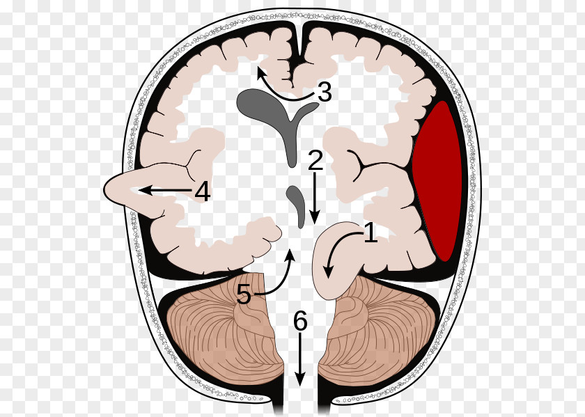 Hole Burr Brain Herniation Intracranial Pressure Traumatic Injury Cerebellar Tentorium PNG