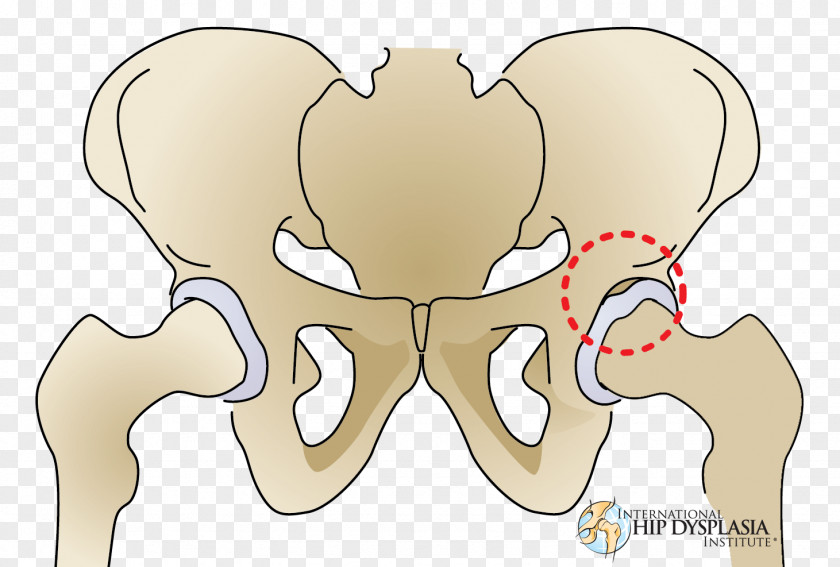Torn Joint Hip Dysplasia Acetabular Labrum Acetabulum PNG