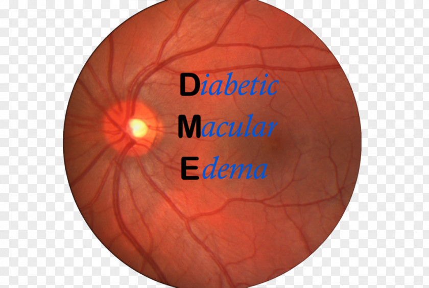 Edema Macular Macula Of Retina Diabetic Retinopathy PNG