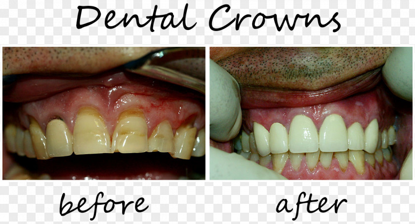 Crown Smiles Of Cary Family Dentistry Jody Waddell DDS FAGD Tooth PNG
