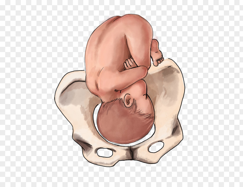 Pregnancy Fetal Position Childbirth Infant Breech Birth PNG