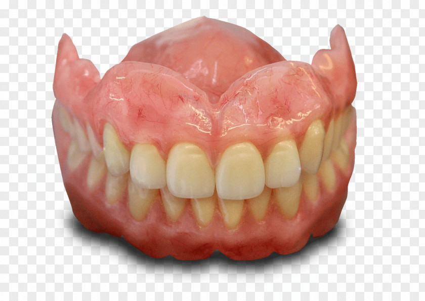 Implant Tooth Dentures Dentistry Dental Laboratory PNG